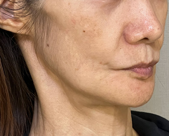 ミニフェイスリフト(頬のたるみ取り),ミニフェイスリフトで頬のたるみを改善した症例写真,Before,ba_minilift018_b02.jpg