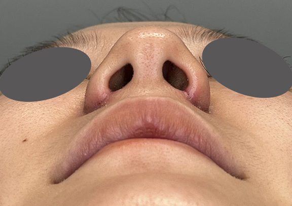 症例写真,鼻翼縮小で小鼻の横への張り出しを改善した症例写真,After術後5日目(抜糸直後),ba_biyoku057_b02.jpg