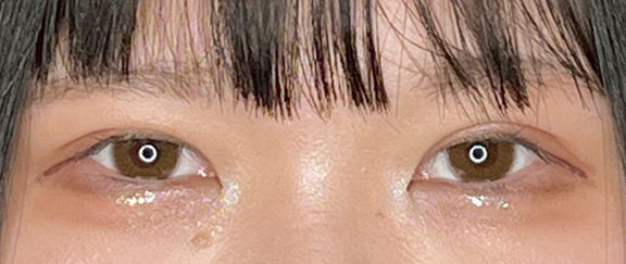 症例写真,眠たそうなまぶたを二重まぶた・埋没法(一針固定)で施術した症例写真,After(メイクあり)<br/>
(1ヶ月後),