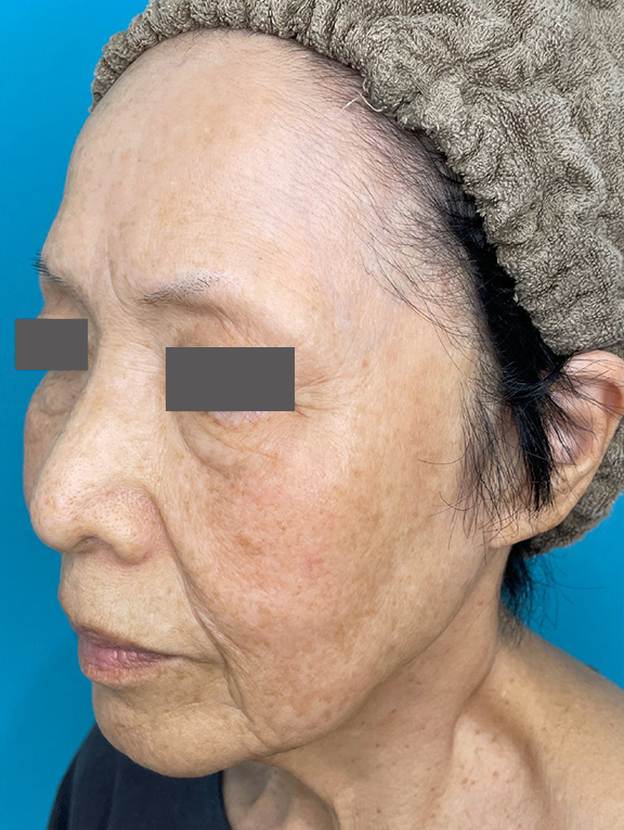 症例写真,フォトフェイシャルM22でシミ・そばかすを薄くした症例写真,After(4回目照射後),ba_ipl013_b02.jpg