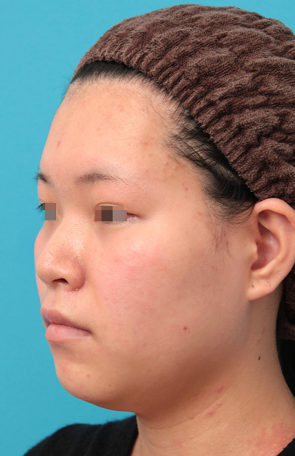 症例写真,鼻シリコンプロテーゼ+鼻先耳介軟骨移植+小鼻縮小を行った20代女性の症例写真,Before,ba_ryubi1065_b02.jpg