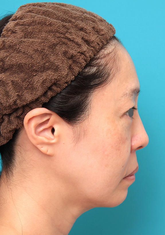 ミディアムフェイスリフト,ミディアムフェイスリフトを行った50代女性症例写真,Before,ba_mediumlift024_b02.jpg