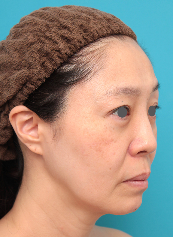 ミディアムフェイスリフト,ミディアムフェイスリフトを行った50代女性症例写真,Before,ba_mediumlift024_b03.jpg