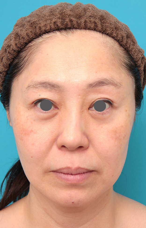 ミディアムフェイスリフト,ミディアムフェイスリフトを行った50代女性症例写真,手術前,mainpic_mediumlift024a.jpg
