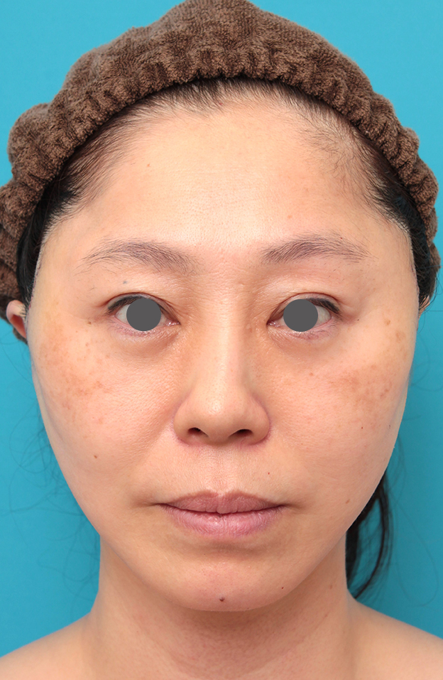 ミディアムフェイスリフト,ミディアムフェイスリフトを行った50代女性症例写真,手術直後,mainpic_mediumlift024b.jpg