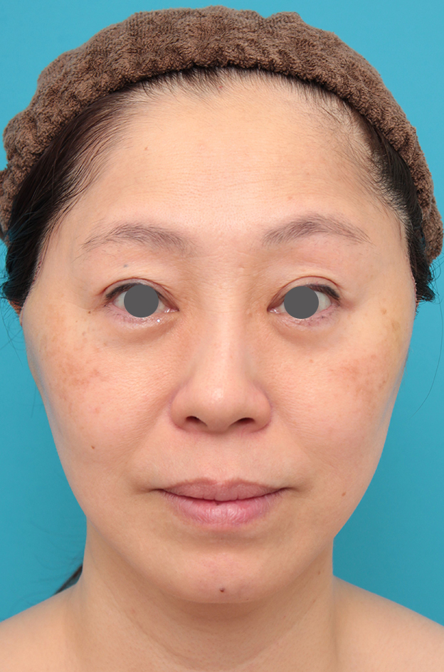 ミディアムフェイスリフト,ミディアムフェイスリフトを行った50代女性症例写真,1週間後,mainpic_mediumlift024c.jpg