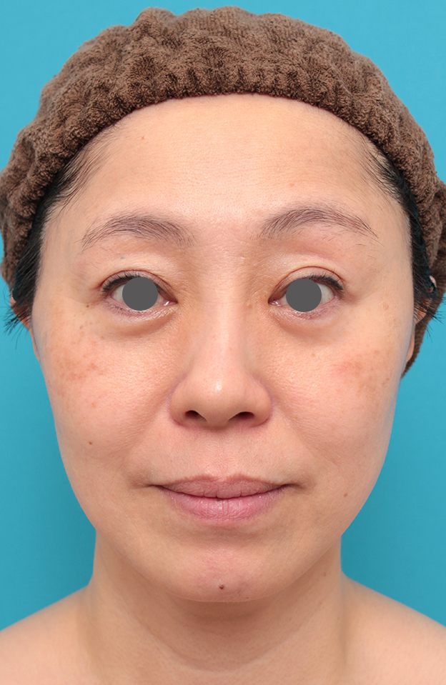ミディアムフェイスリフト,ミディアムフェイスリフトを行った50代女性症例写真,3週間後,mainpic_mediumlift024d.jpg