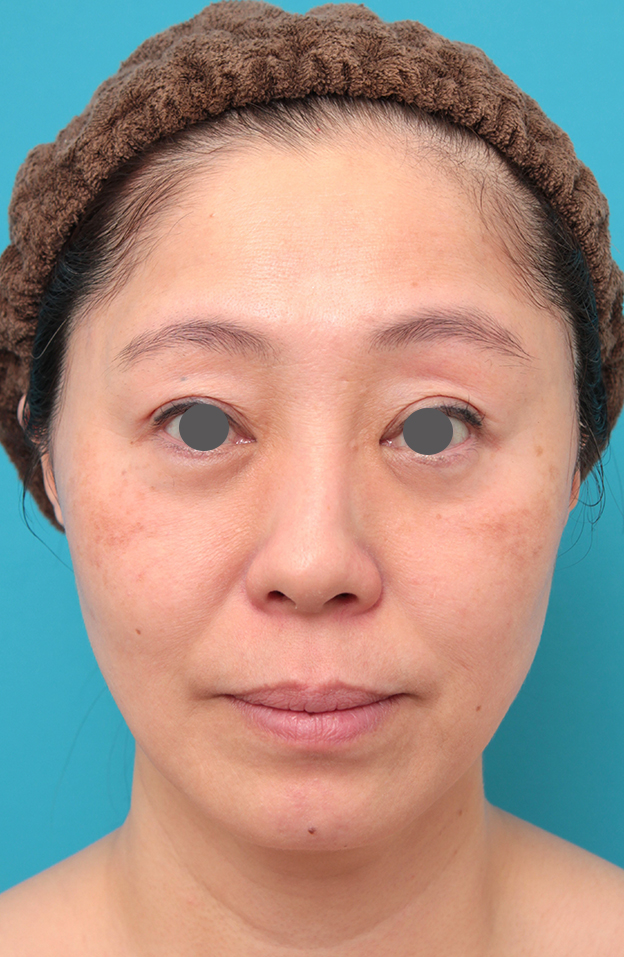 ミディアムフェイスリフト,ミディアムフェイスリフトを行った50代女性症例写真,6ヶ月後,mainpic_mediumlift024e.jpg