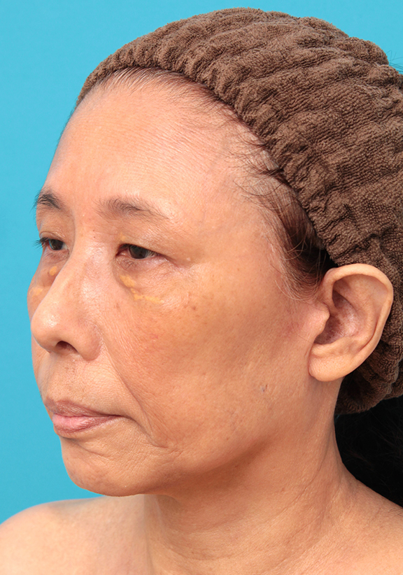 フルフェイスリフト,フェイスリフトを行った60代女性症例写真,After(6ヶ月後),ba_facelift008_b02.jpg