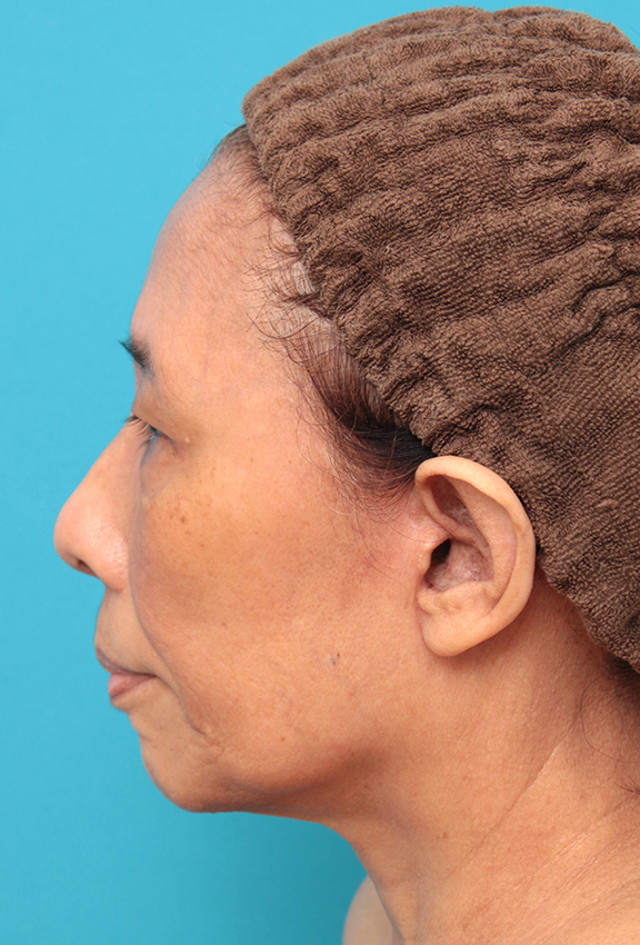 フルフェイスリフト,フェイスリフトを行った60代女性症例写真,After(6ヶ月後),ba_facelift008_b03.jpg