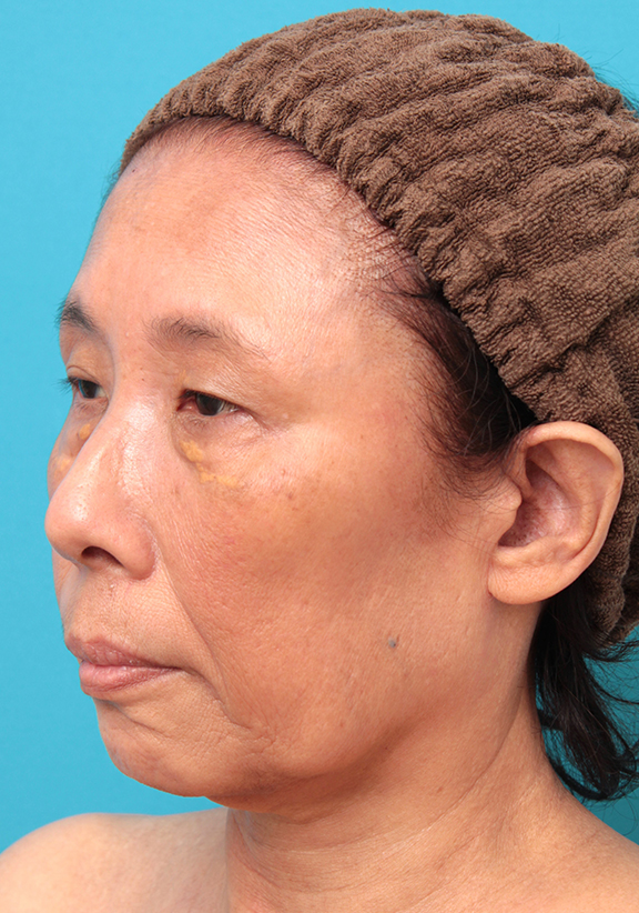 フルフェイスリフト,フェイスリフトを行った60代女性症例写真,Before,ba_facelift008_b02.jpg