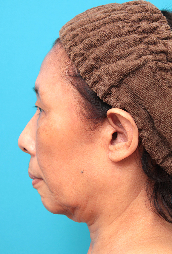 フルフェイスリフト,フェイスリフトを行った60代女性症例写真,Before,ba_facelift008_b03.jpg