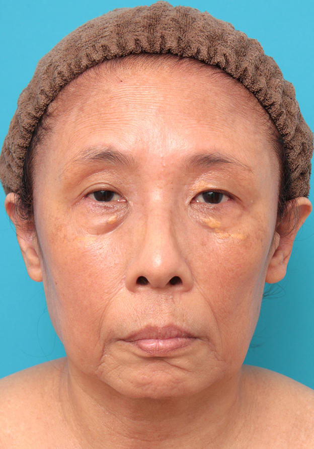 フルフェイスリフト,フェイスリフトを行った60代女性症例写真,手術前,mainpic_facelift008a.jpg