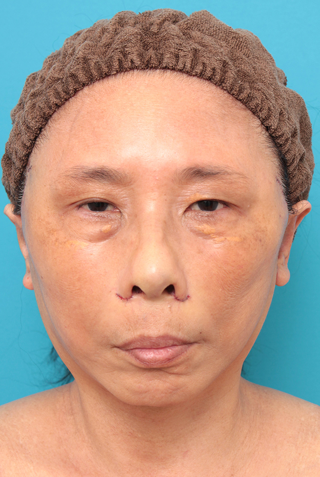 フルフェイスリフト,フェイスリフトを行った60代女性症例写真,手術直後,mainpic_facelift008b.jpg