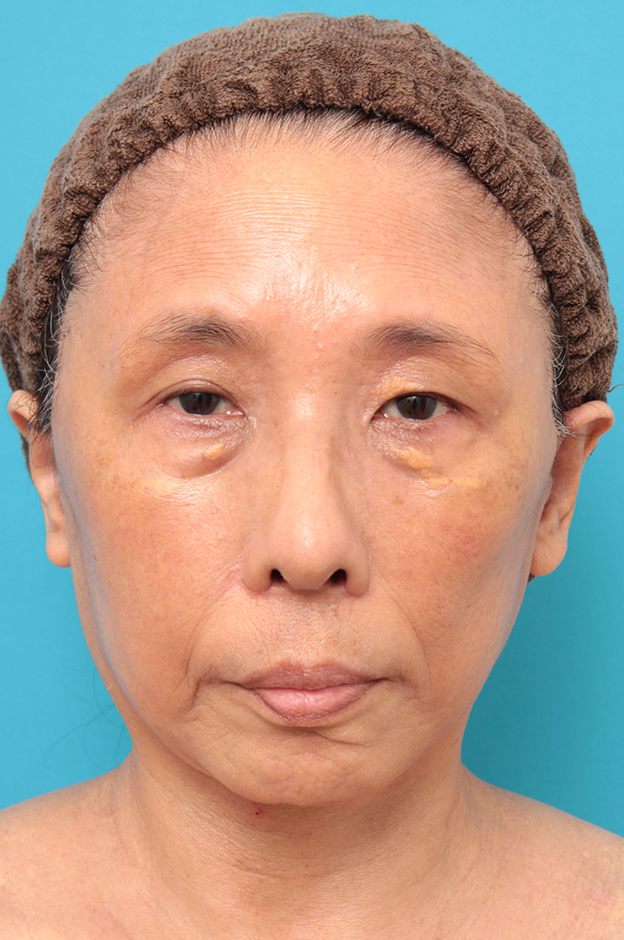 フルフェイスリフト,フェイスリフトを行った60代女性症例写真,1週間後,mainpic_facelift008c.jpg