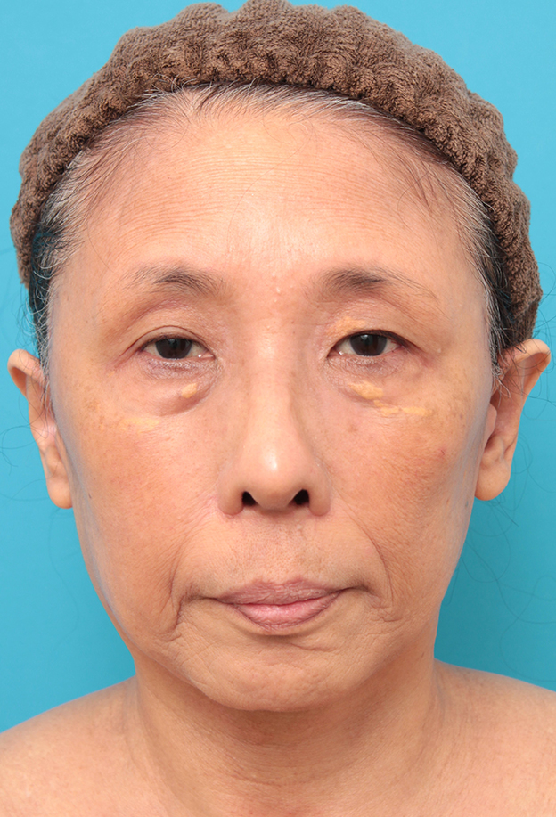 フルフェイスリフト,フェイスリフトを行った60代女性症例写真,3週間後,mainpic_facelift008d.jpg