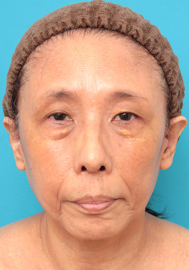 フルフェイスリフト,フェイスリフトを行った60代女性症例写真,6ヶ月後,mainpic_facelift008e.jpg