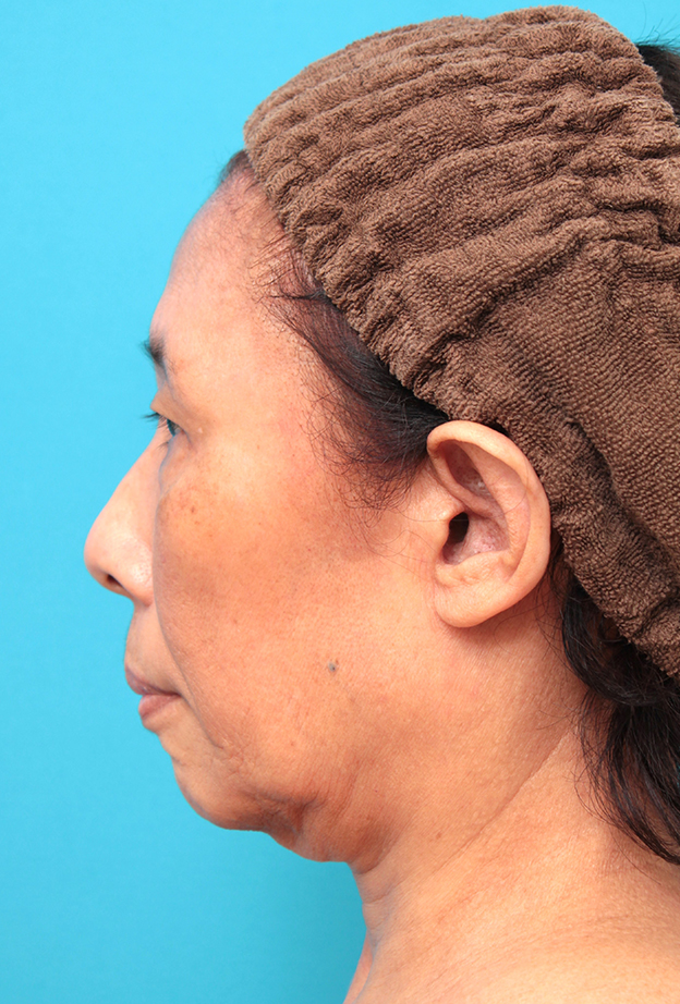 フルフェイスリフト,フェイスリフトを行った60代女性症例写真,手術前,mainpic_facelift008f.jpg