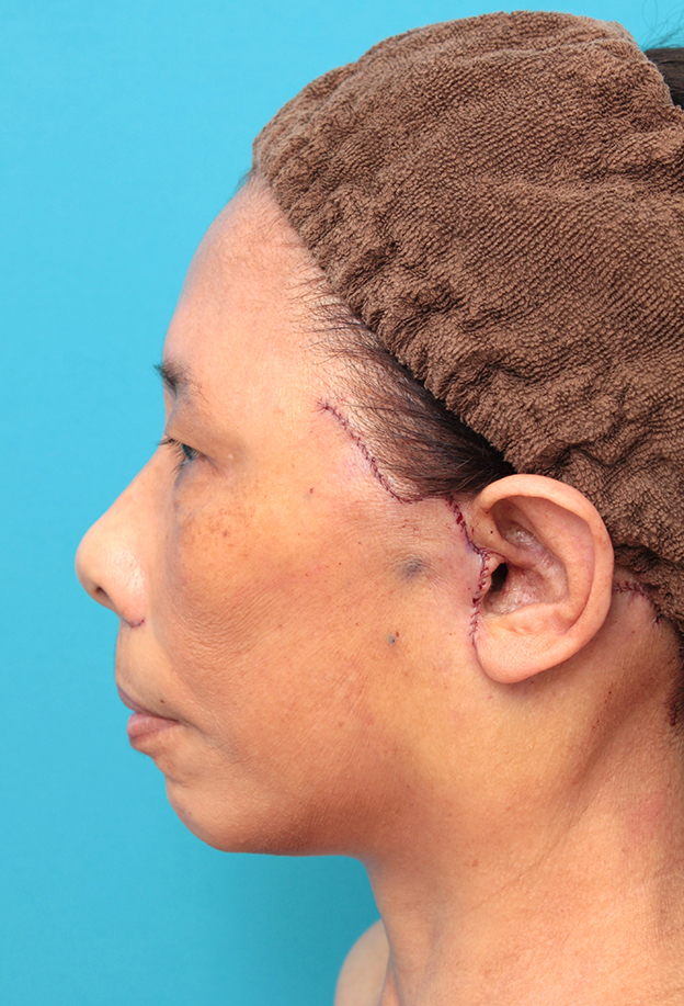 フルフェイスリフト,フェイスリフトを行った60代女性症例写真,手術直後,mainpic_facelift008g.jpg