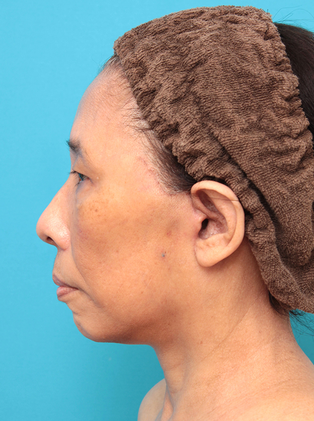 フルフェイスリフト,フェイスリフトを行った60代女性症例写真,1週間後,mainpic_facelift008h.jpg