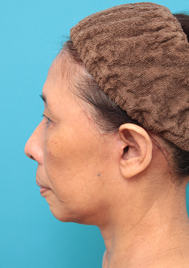 フルフェイスリフト,フェイスリフトを行った60代女性症例写真,3週間後,mainpic_facelift008i.jpg