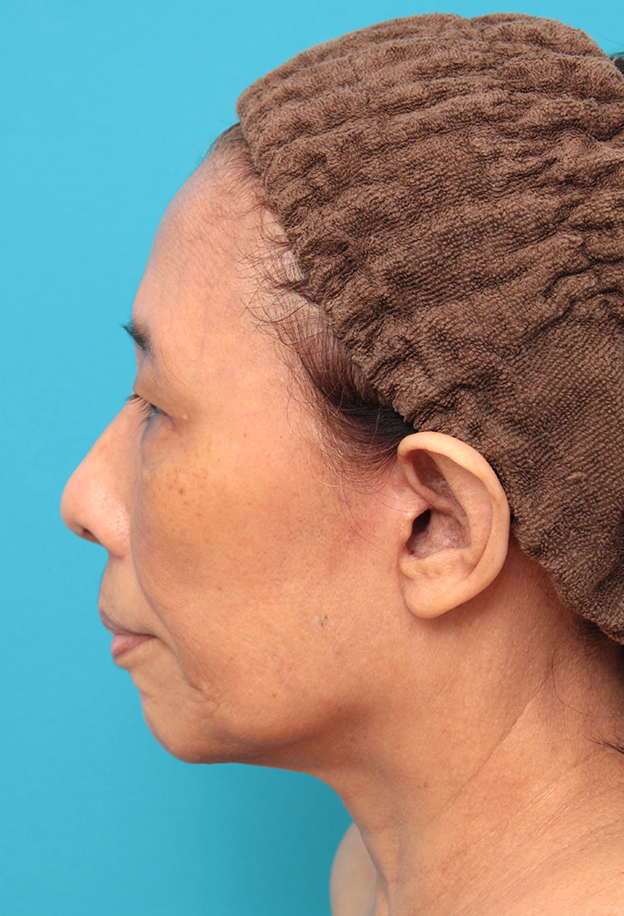 フルフェイスリフト,フェイスリフトを行った60代女性症例写真,6ヶ月後,mainpic_facelift008j.jpg