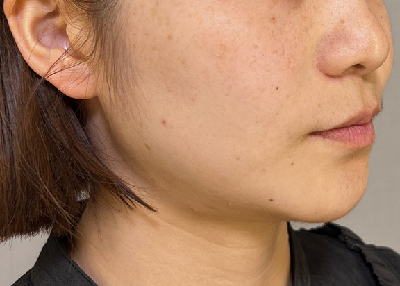 ウルセラシステム,ウルセラシステムとエラボトックスでフェイスラインをすっきりさせた症例写真,Before,ba_ulthera039_b02.jpg