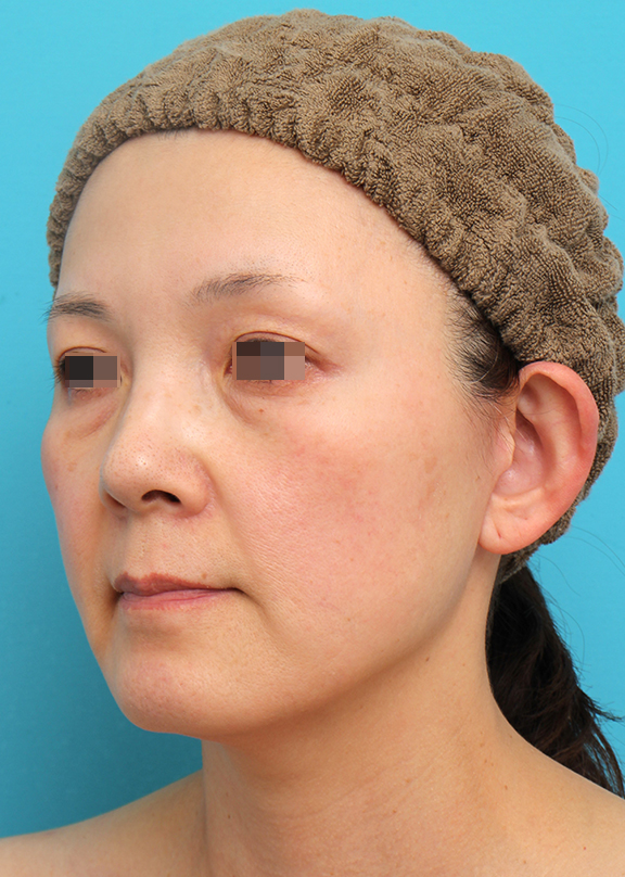 ミニフェイスリフト(頬のたるみ取り),ミニフェイスリフトを行った50代女性症例写真,After(6ヶ月後),ba_minilift019_b02.jpg