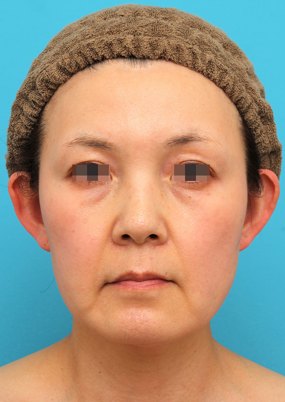 ミニフェイスリフト（頬のたるみ取り）,ミニフェイスリフトを行った50代女性症例写真,Before,ba_minilift019_b01.jpg
