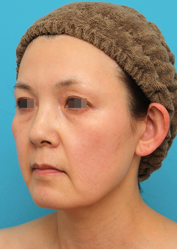 ミニフェイスリフト(頬のたるみ取り),ミニフェイスリフトを行った50代女性症例写真,Before,ba_minilift019_b02.jpg