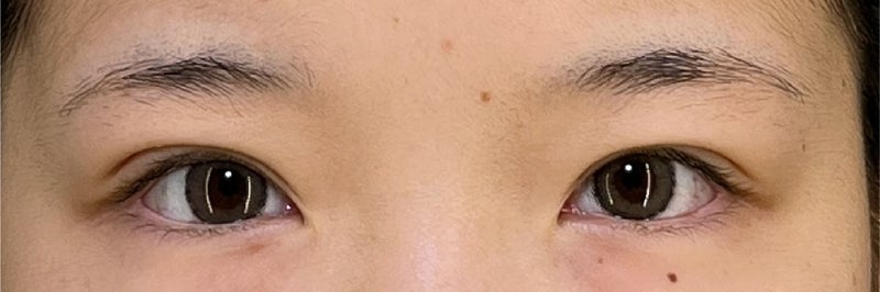 睫毛のキワが見えるような幅にした二重まぶた･埋没法の症例写真,After（メイクなし）
（1ヶ月後）,ba_maibotsu078_a01.jpg