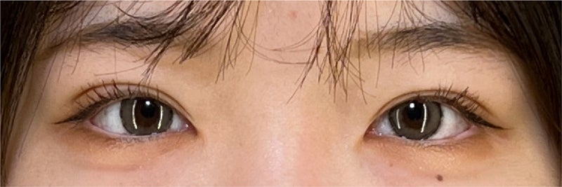 症例写真,睫毛のキワが見えるような幅にした二重まぶた・埋没法の症例写真,After(メイクあり)<br/>
(1ヶ月後),