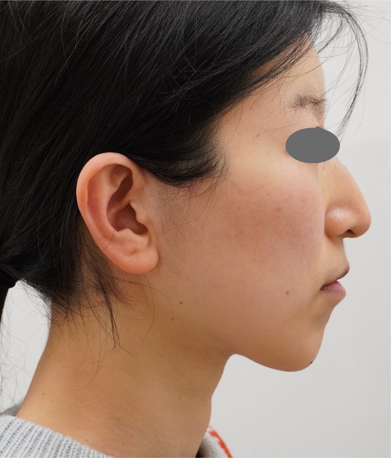 ミニリフト、脂肪吸引、あごヒアルロン酸でフェイスラインをすっきりさせ、1年後も効果が持続している症例写真,After（1年後）,ba_minilift021_a01.jpg