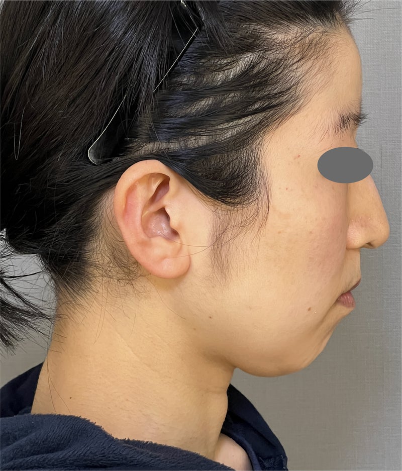 ミニリフト、脂肪吸引、あごヒアルロン酸でフェイスラインをすっきりさせ、1年後も効果が持続している症例写真,Before,ba_minilift021_b01.jpg