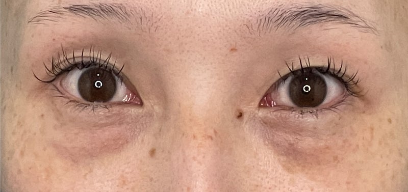 CO2レーザーを使った目の下の切らない脂肪取りの症例写真,After（1ヶ月後）,ba_shibo_under014_a01.jpg