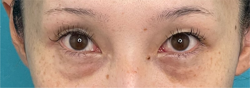 症例写真,CO2レーザーを使った目の下の切らない脂肪取りの症例写真,After(1ヶ月後),ba_shibo_under014_b02.jpg