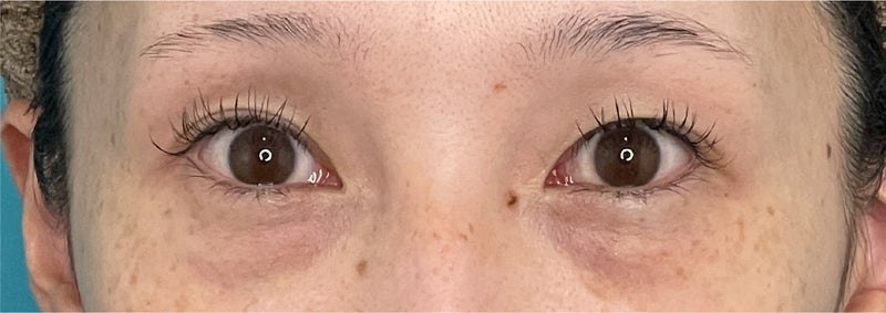 症例写真,CO2レーザーを使った目の下の切らない脂肪取りの症例写真,After(1ヶ月後),ba_shibo_under014_b03.jpg