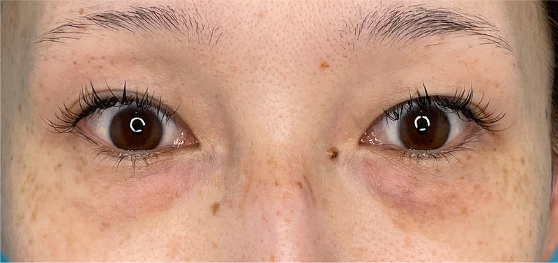 CO2レーザーを使った目の下の切らない脂肪取りの症例写真,Before,ba_shibo_under014_b01.jpg