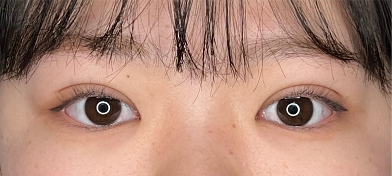 症例写真,二重まぶた・埋没法(一針固定)で眠たそうなまぶたを改善した症例写真,After(メイクあり)<br/>
(1ヶ月後),