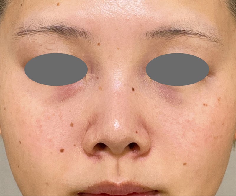 鼻翼縮小（小鼻縮小）,張り出し感のあった小鼻を鼻翼縮小（小鼻縮小）でスッキリさせた症例写真,After（3ヶ月後）,ba_biyoku058_a01.jpg