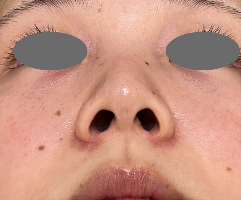 症例写真,張り出し感のあった小鼻を鼻翼縮小(小鼻縮小)でスッキリさせた症例写真,After(3ヶ月後),ba_biyoku058_b02.jpg