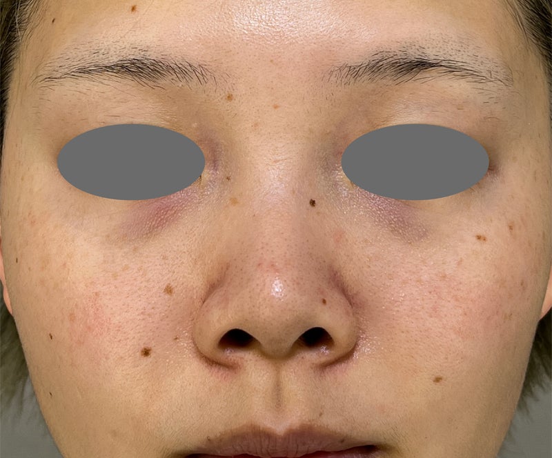 鼻翼縮小（小鼻縮小）,張り出し感のあった小鼻を鼻翼縮小（小鼻縮小）でスッキリさせた症例写真,Before,ba_biyoku058_b01.jpg