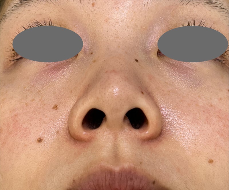 症例写真,張り出し感のあった小鼻を鼻翼縮小(小鼻縮小)でスッキリさせた症例写真,Before,ba_biyoku058_b02.jpg
