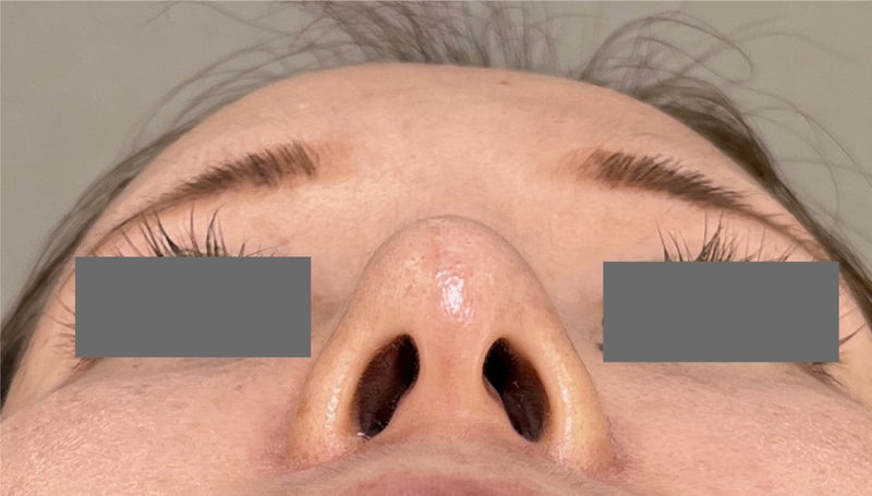 症例写真,耳介軟骨移植・隆鼻プロテーゼをおこない、スマートな鼻になった症例写真,After(3ヶ月後),ba_jikai053_b04.jpg