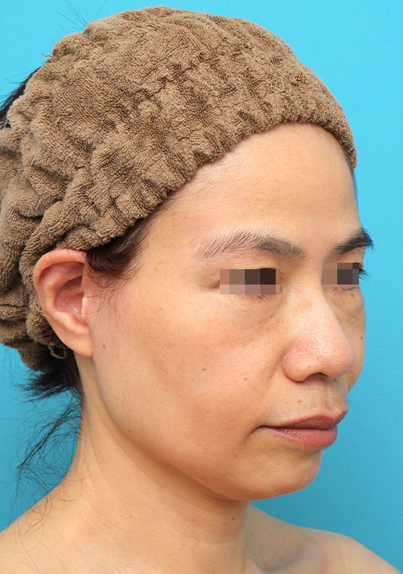 ミディアムフェイスリフト,ミディアムフェイスリフトを行った50代女性の症例写真,After(6ヶ月後),ba_mediumlift025_b02.jpg