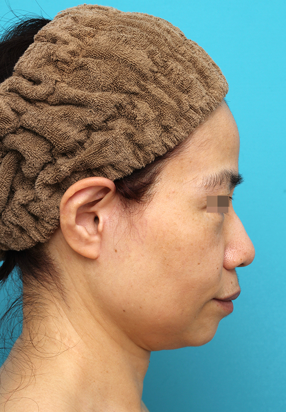ミディアムフェイスリフト,ミディアムフェイスリフトを行った50代女性の症例写真,After(6ヶ月後),ba_mediumlift025_b03.jpg