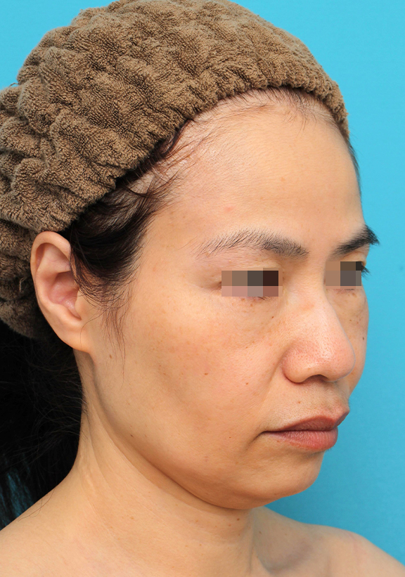 ミディアムフェイスリフト,ミディアムフェイスリフトを行った50代女性の症例写真,Before,ba_mediumlift025_b02.jpg