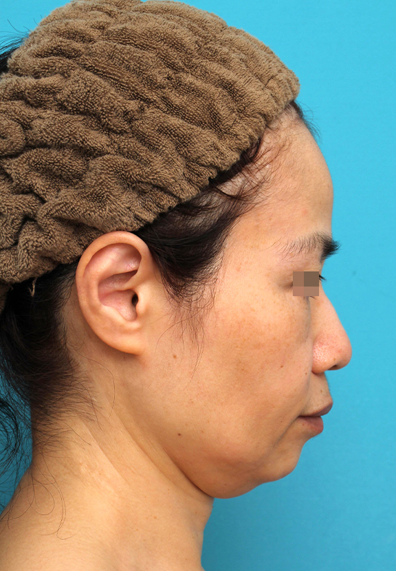 ミディアムフェイスリフト,ミディアムフェイスリフトを行った50代女性の症例写真,Before,ba_mediumlift025_b03.jpg