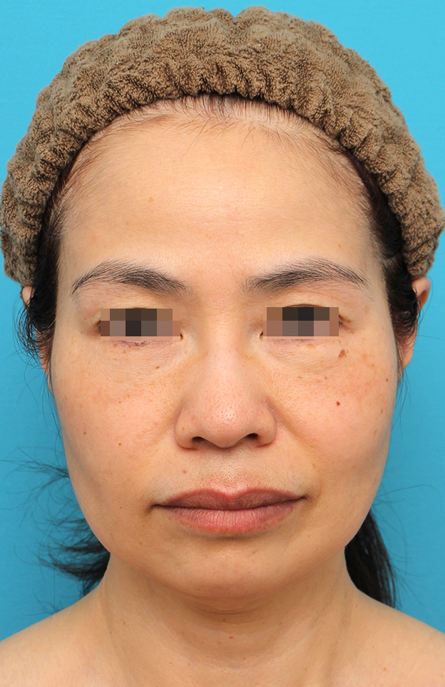 ミディアムフェイスリフト,ミディアムフェイスリフトを行った50代女性の症例写真,手術前,mainpic_mediumlift025a.jpg
