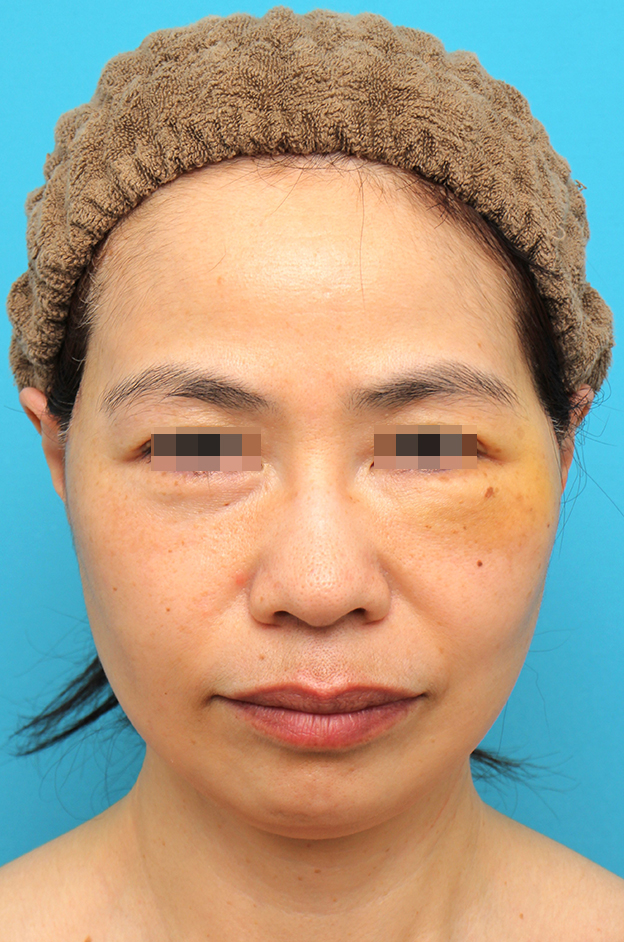 ミディアムフェイスリフト,ミディアムフェイスリフトを行った50代女性の症例写真,1週間後,mainpic_mediumlift025c.jpg